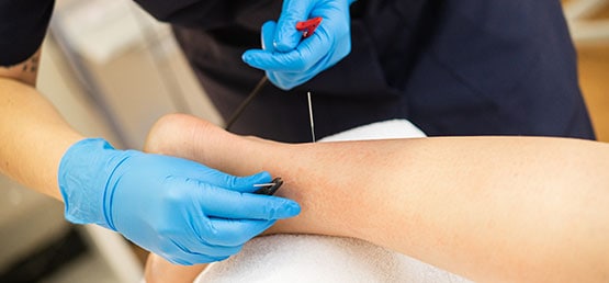 A patient receiving dry needling from the therapist.