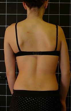 Woman after a therapy to her dislocated back.